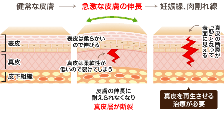 妊娠線・肉割れの原因イメージ図