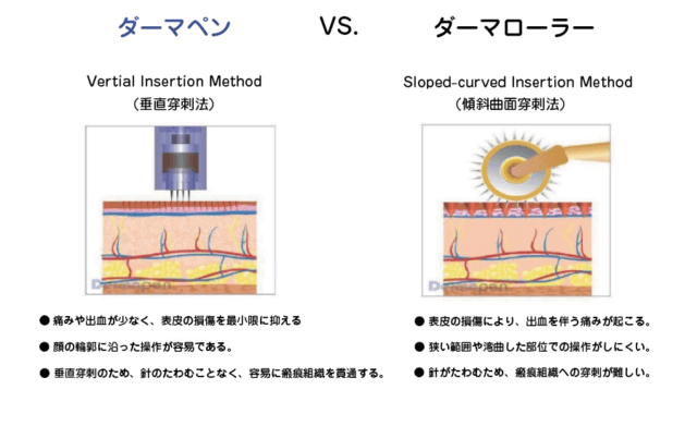 高田馬場皮膚科・形成外科のダーマペン ダーマローラの比較